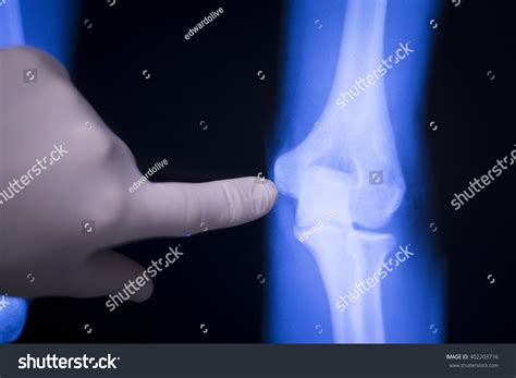Elbow Forearm Arm Joint Medical Xray Stock Photo Edit Now 402203716
