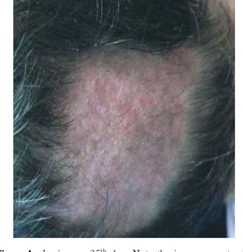 Figure 4 From Kerion Type Of Tinea Capitis Treated With Double Pulse