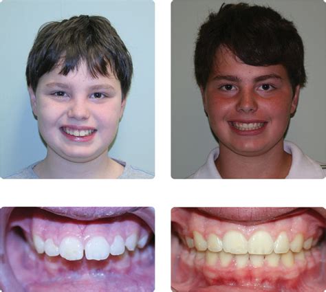 Overbite J Cox Orthodontics J Cox Orthodontics
