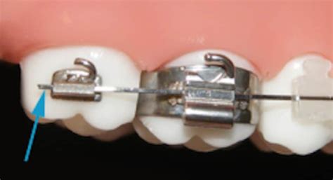 What Is A Poking Wire In Braces And Orthodontics Archwired