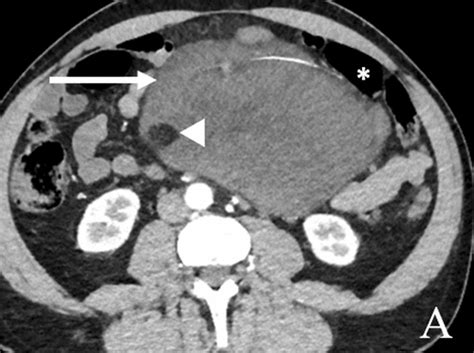 61 Year Old Male With Myxoid Liposarcoma A Axial Contrast Enhanced Ct