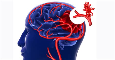 Brain Aneurysm Symptomstreatment Atlantic Brain Spine