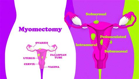 Insurance coverage is the amount of risk or liability covered for an individual or entity by way of insurance services. The Best Myomectomy Surgeons in india | Fibroid surgery, Fibroids, Uterine fibroids