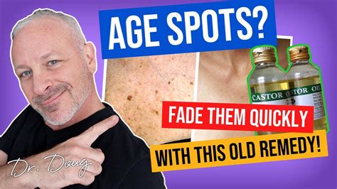Age Spots Natural Remedy With Castor Oil Youtube