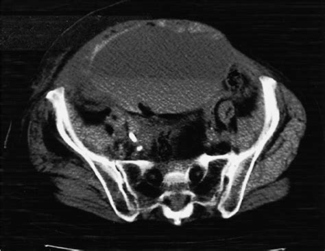 An Unenhanced Ct Scan Of The Abdomen Showing A Large Mass In The