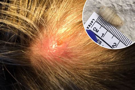 Woman With Wriggly Itchy Lumps On Her Scalp Discovers Theyre Botfly