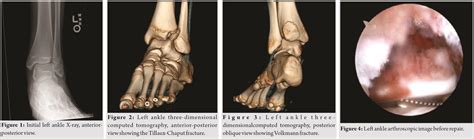 A Rare Cooccurrence Of Tillaux Chaput And Volkmann Fracture In An