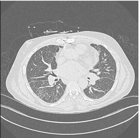 Initial Ct Scan Revealing Hilar Adenopathy Lul Consolidation Versus