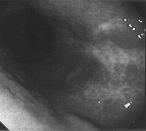 Radiographic Findings Of Primary B Cell Lymphoma Of The Stomach Low