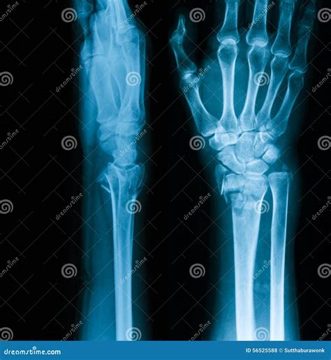 X Ray Image Of Wrist Joint Ap And Lateral View Stock Photo Image Of