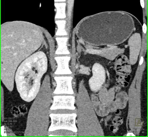 Adenoma Left Adrenal Gland Adrenal Case Studies Ctisus Ct Scanning