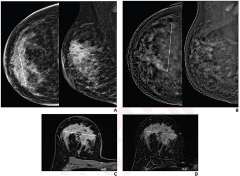 Contrast Enhanced Mammography Vs Mri Neoadjuvant Therapy Response In