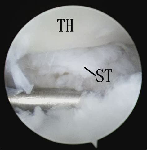 Arthroscopic Capsular Release Of The Talocalcaneonavicular Joint