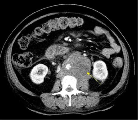 Ct Scan Of Abdomen Showing A Mass Axial Contrast Enhanced Ct Image