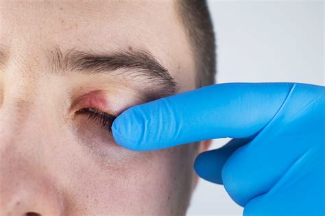 Blepharitis 8 Things To Know About Eyelid Inflammation The Healthy