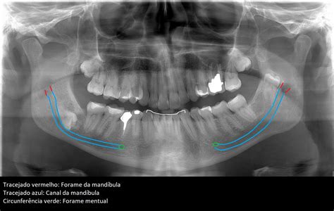 Anatomia Radiográfica e Tomográfica aplicada à Odontologia Parte II