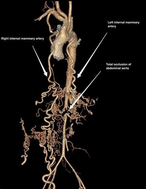 Cureus Total Occlusion Of Abdominal Aorta In Takayasu Arteritis