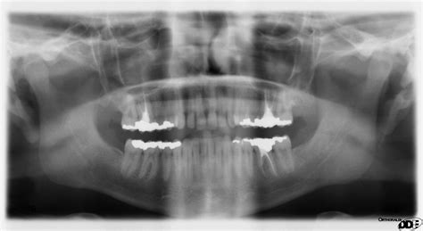 Dental Radiography Wikidoc