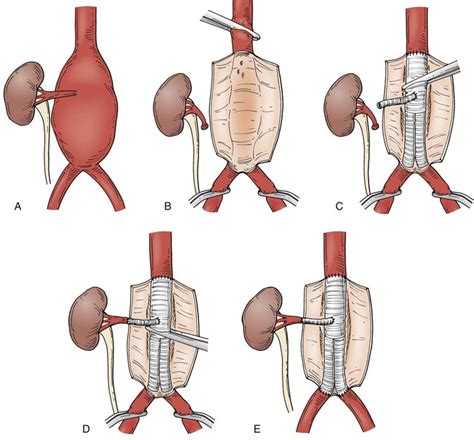 Abdominal Aortic Aneurysms Thoracic Key