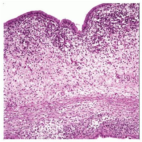 Embryonal Rhabdomyosarcoma | Basicmedical Key