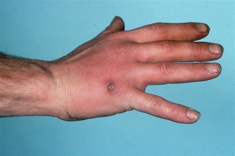 Inflamed Lymph Vessels In The Hand Photograph By St Bartholomew