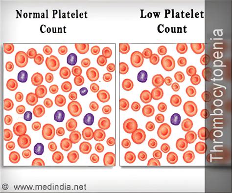 Thrombocytopenia Low Platelet Count Causes Symptoms Diagnosis Treatment