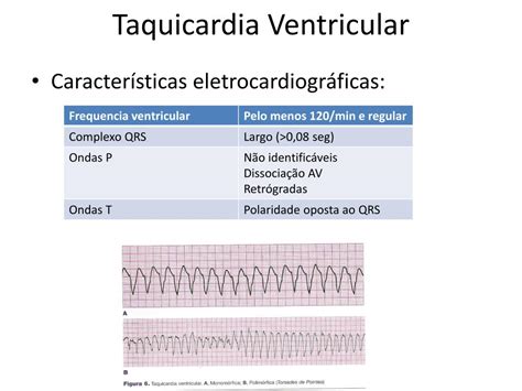 Criterios De Taquicardia Ventricular