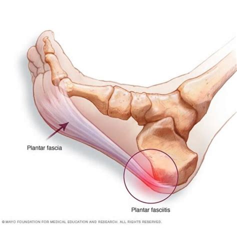 Plantar Fasciitis Heel That Foot Pain