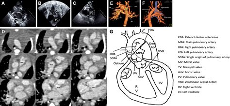 Single Origin Of Right And Left Pulmonary Arteries From Ascending Aorta