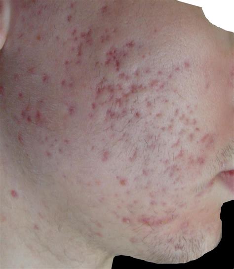 Red Marks On My Face What Can I Do To Fix It Acne