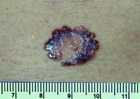 Pigmented Nodular Basal Cell Carcinomas In Differential Diagnosis With