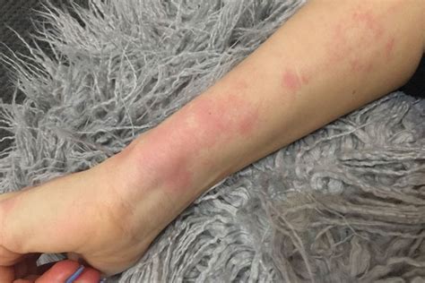 Can You Show Pictures Of Lupus Skin Rash Htq