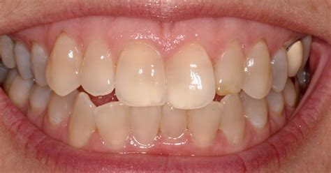 Welcome To Design Inn Blog Brighten Your Yellowish Teeth With Photoshop