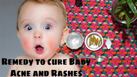 Home Remedy To Cure Baby Acne Rashes And Allergy How To Cure Baby
