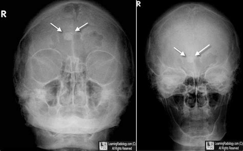 Learning Radiology Osteoma Sinus