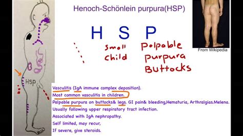Henoch Schonlein Purpura Symptoms