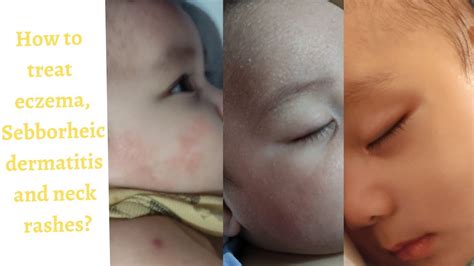 Prescribed Effective Products For Baby Neck Rash Sebborheic Dermatitis