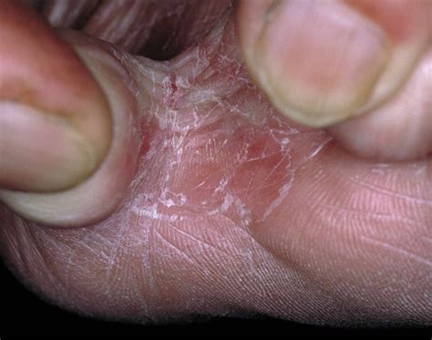 Athletes Foot Symptoms Causes And Treatment