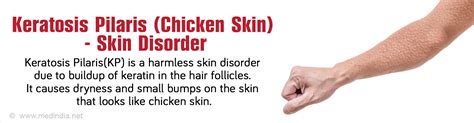 Keratosis Pilaris Chicken Skin Skin Disorder Causes Symptoms