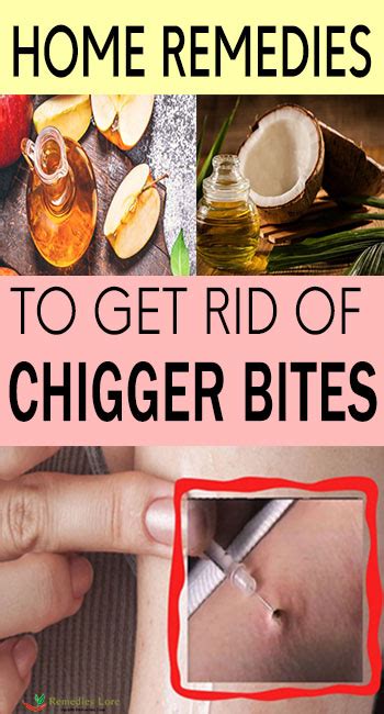 Home Remedies To Get Rid Of Chigger Bites Remedies Lore