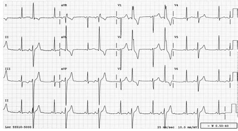 Dr Smiths Ecg Blog Pvc Or Aberrant Conduction Another Guest Post