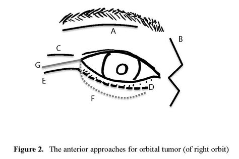 Location Based Surgical Approaches For Orbital Tumor Resection