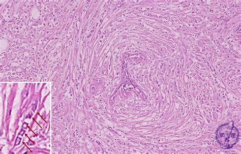 14breast 7 Invasive Lobular Carcinomapathology Core Pictures