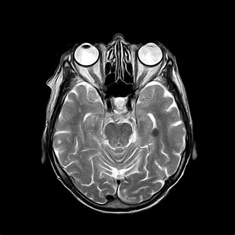 New Mri Technique Can Detect Early Dysfunction Of The Blood Brain