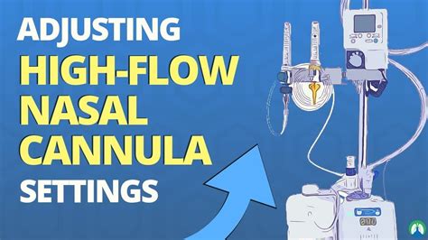 High Flow Nasal Cannula Settings Our Recipes