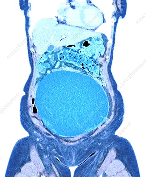 Ovarian Cancer Ct Scan Stock Image C0509698 Science Photo Library