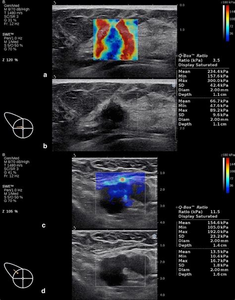 Swe Images With Corresponding B Mode Images Of A Suspicious Axillary