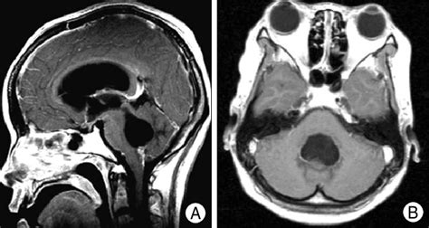 There Are Magnetic Resonance Images On Admission A Mri Image Showed