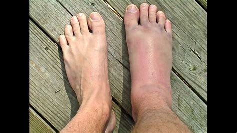 Broken Ankle Vs Sprained Ankle Pictures Canvas Insight
