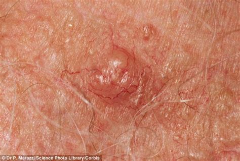 How To Tell If You Have Skin Cancer From Irregular Moles And Other